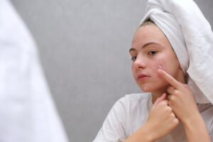 Acne. A teenage girl applying acne medication on her face in front of a mirror. problem skin care