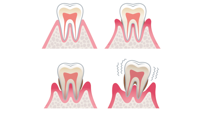 PRODUKTY PRZY PARADONTOZIE