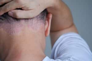 SZAMPON NA ŁUSZCZYCĘ